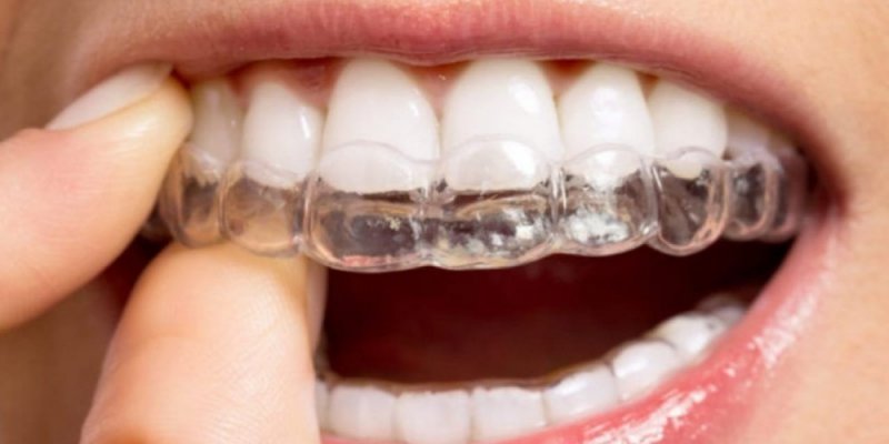 Você conhece o aparelho Invisalign?