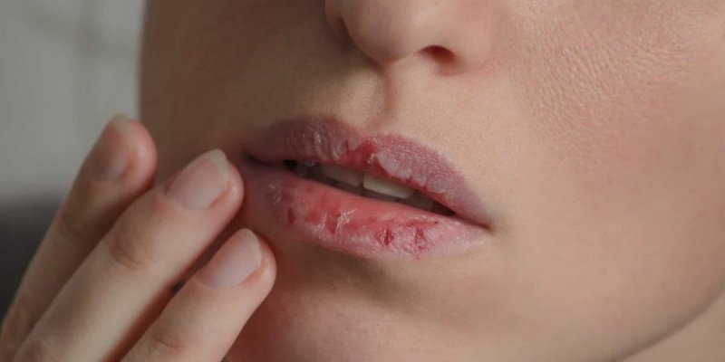 Perda de olfato, lábios rachados e outros sintomas da falta de zinco