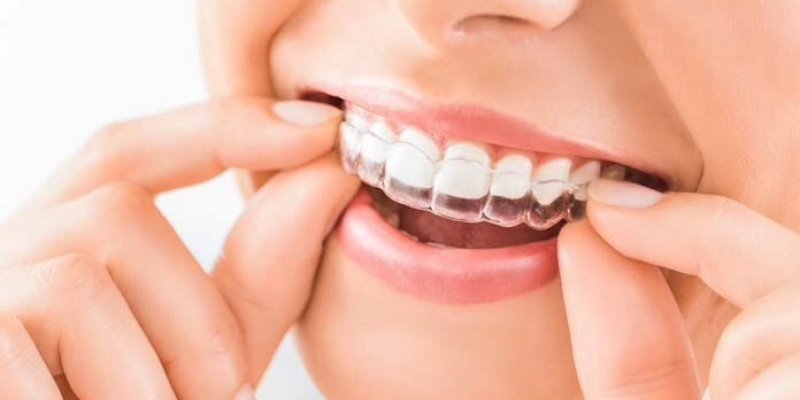 Clareamento dental: o que é, tipos e como funciona o procedimento