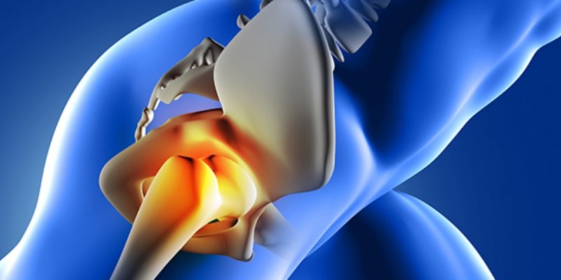 Como identificar e tratar a Luxação do Quadril