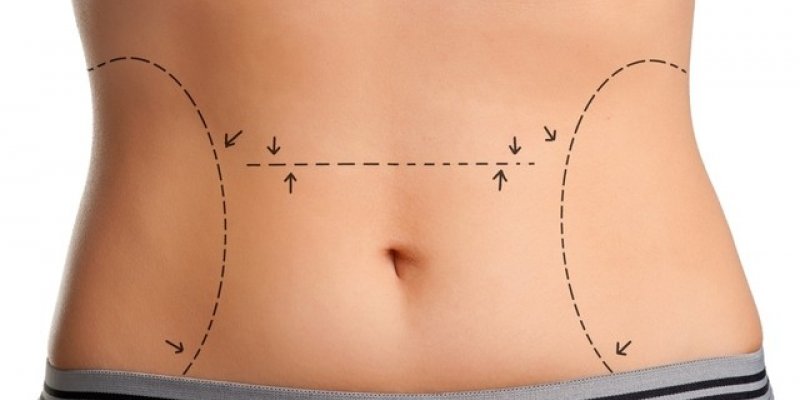 3 Tipos de cirurgia plástica para ficar com a barriga lisinha